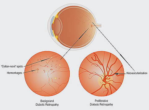 Diabetic Retinopathy