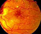 Macular Degeneration in the Eye.