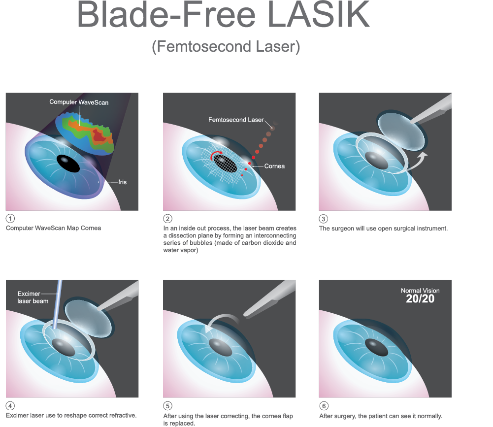 Blade-Free LASIK