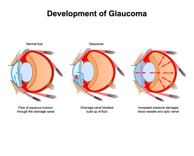 Glaucoma Honolulu | Glaucoma Testing Honolulu | Sugiki Portis Eye HI