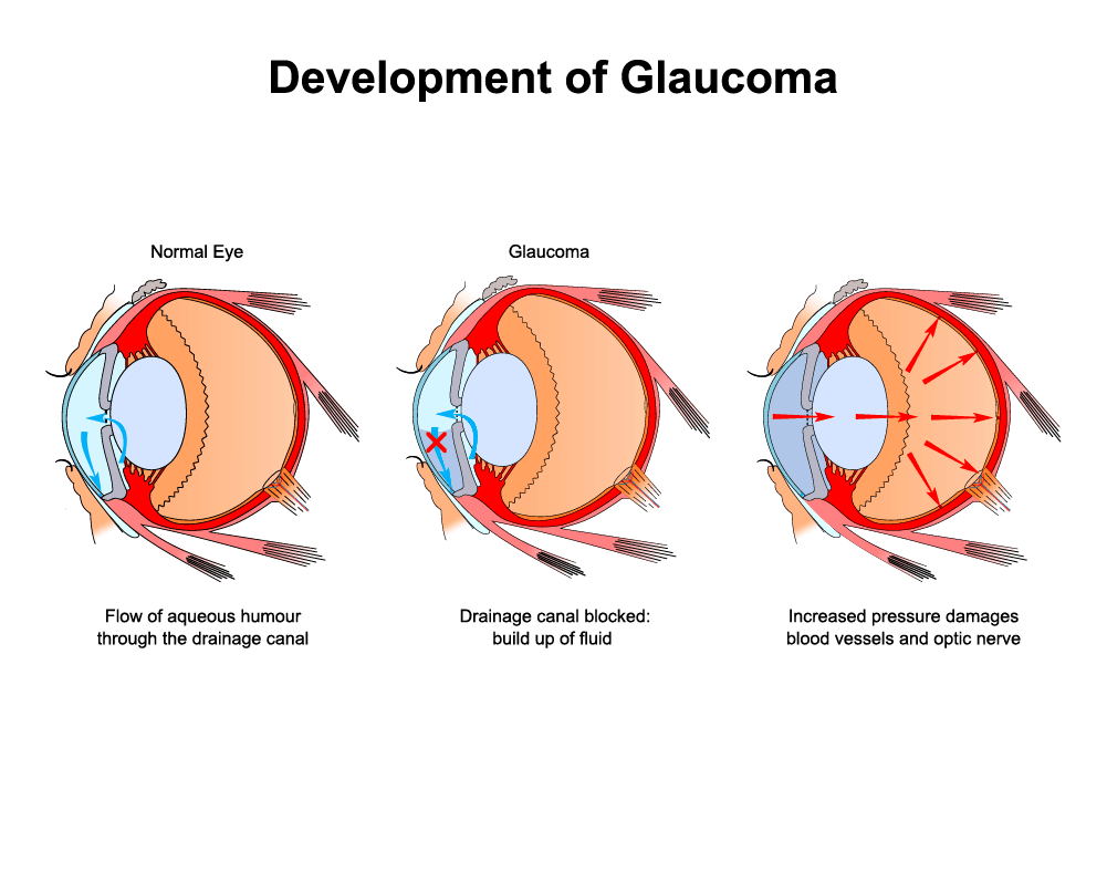 Глаукома офтальмология. Факолитическая глаукома. Глаукома латынь