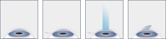 LASIK Eye Surgery Diagram
