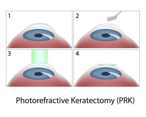 PRK Surgery 