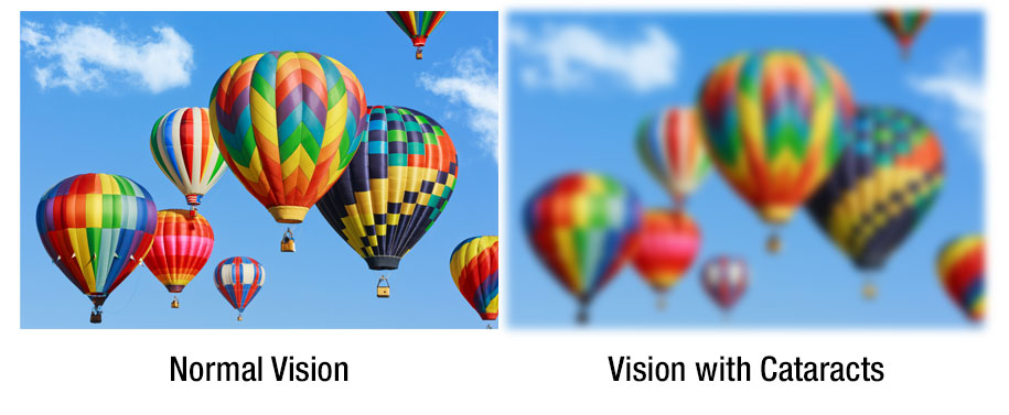 Picture of normal vision side by side with blurry picture representing cataracts
