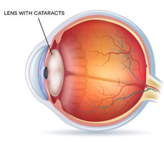 Cataract