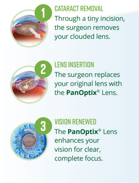 Diagram of steps for the cataract surgery process