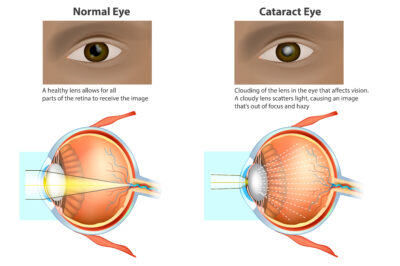 Diagram of normal eye and cataract eye