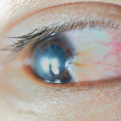pterygium eye