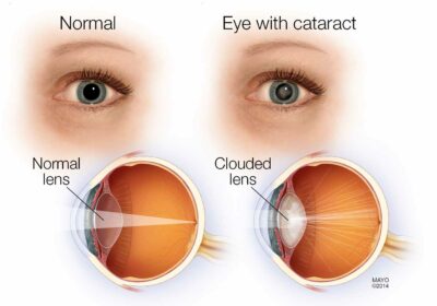 development of cataracts 