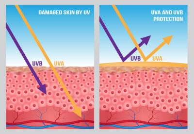 UV Light Damaging Skin