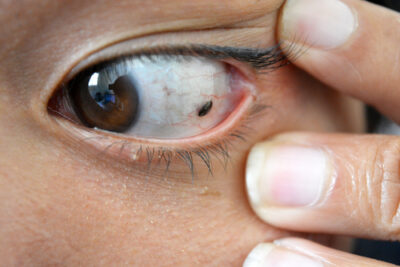 close up of skin cancer in eye 