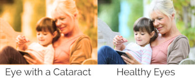 comparison of vision with and without cataracts 