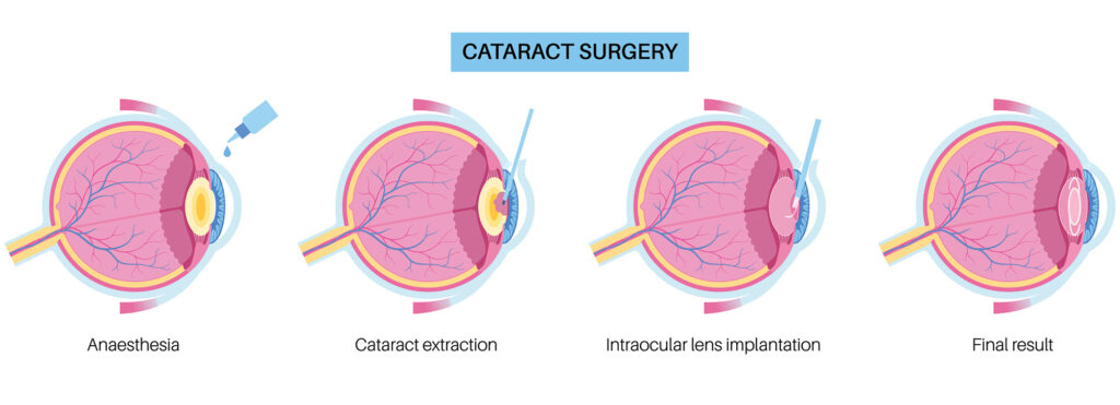 Cataract surgery